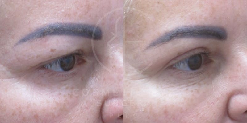 Cosmetic Eye Gallery Before & After Gallery - Patient 178569 - Image 4