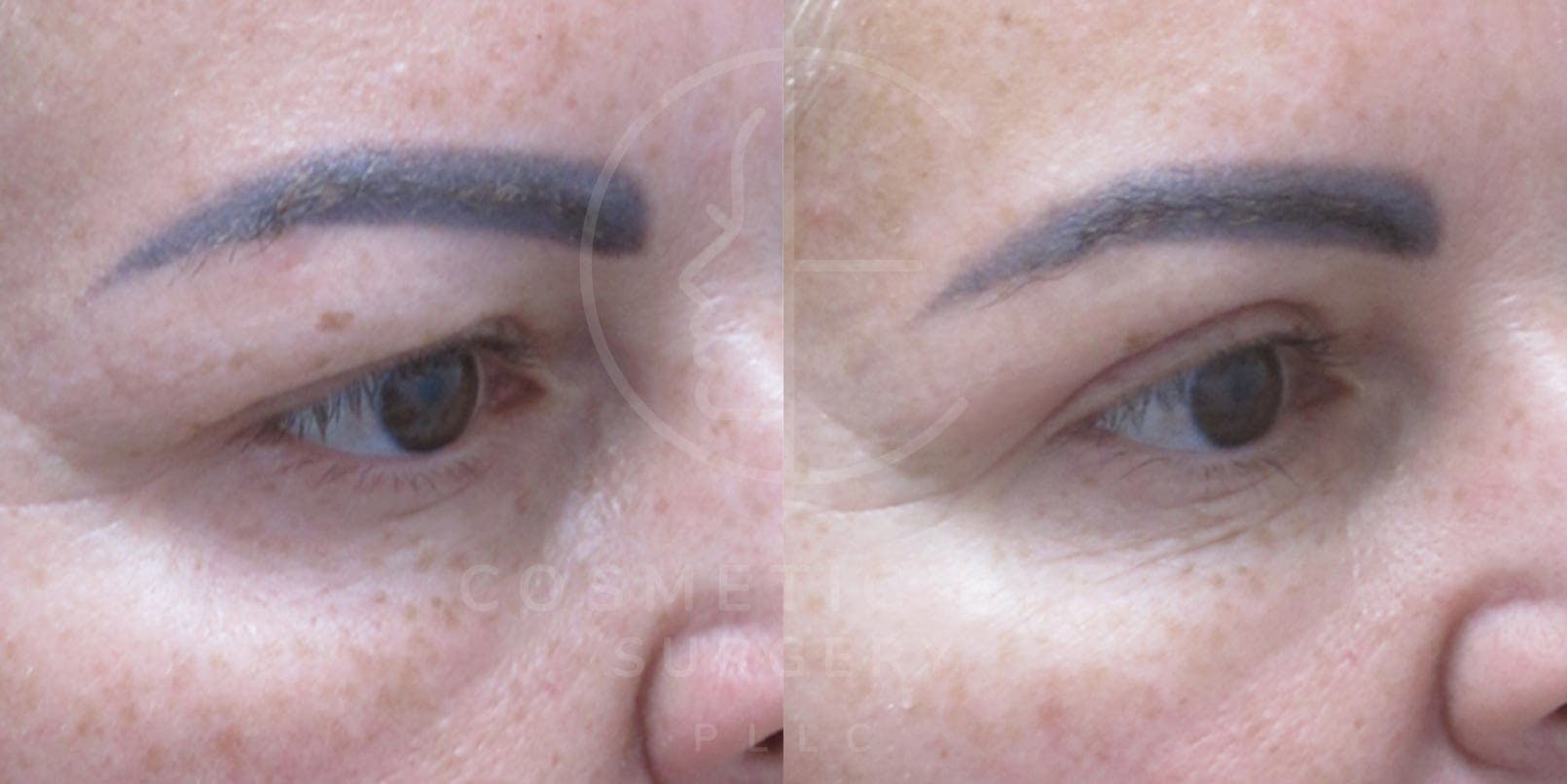 Upper Eyelid Surgery Patient Image #4