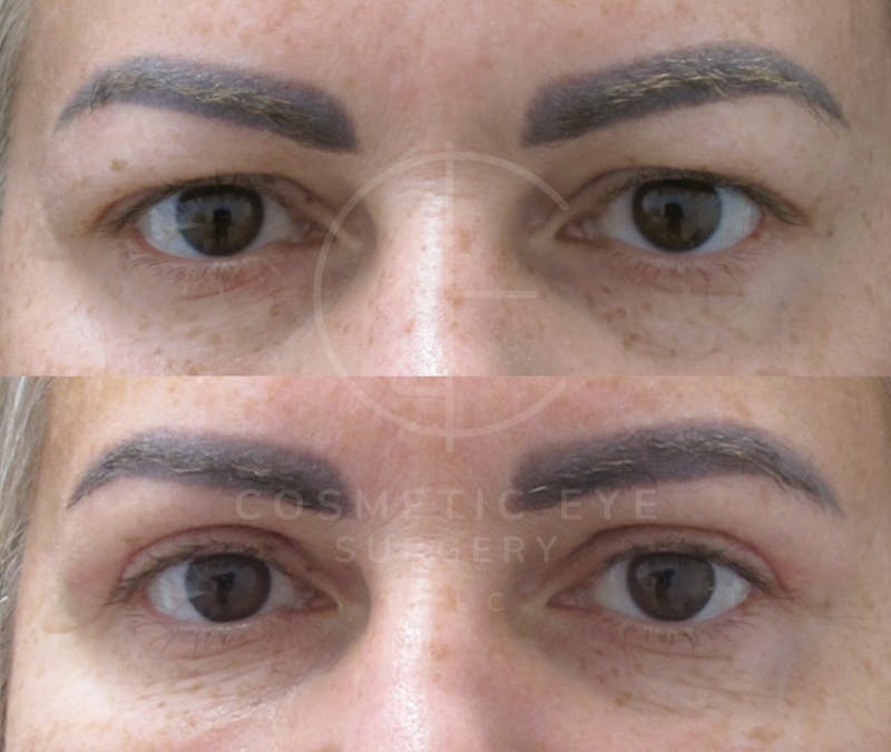 Cosmetic Eye Gallery Before & After Gallery - Patient 178569 - Image 3