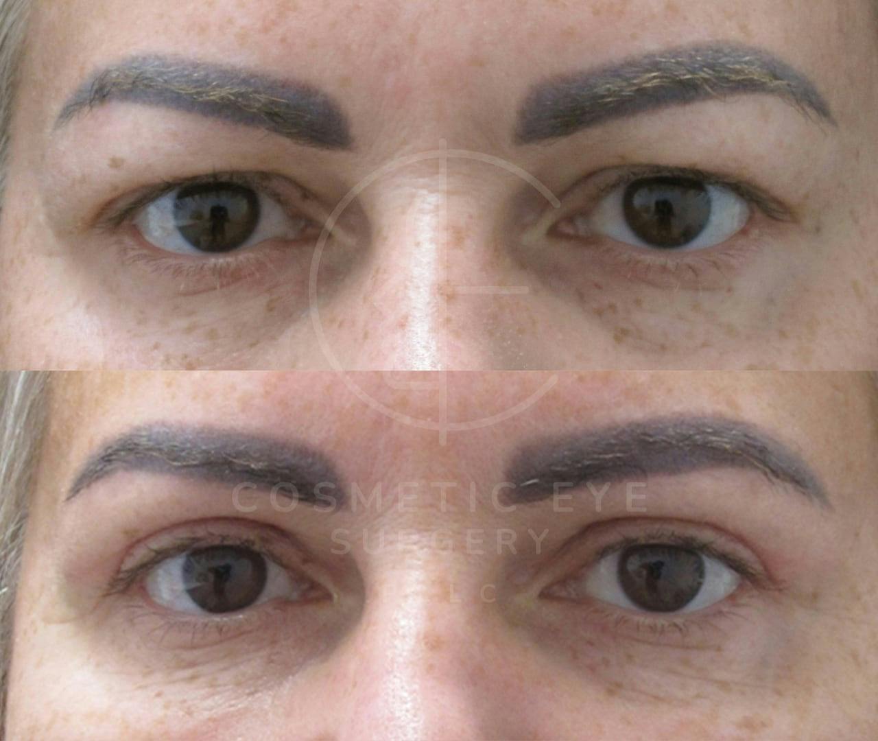 Upper Eyelid Surgery Patient Image #3
