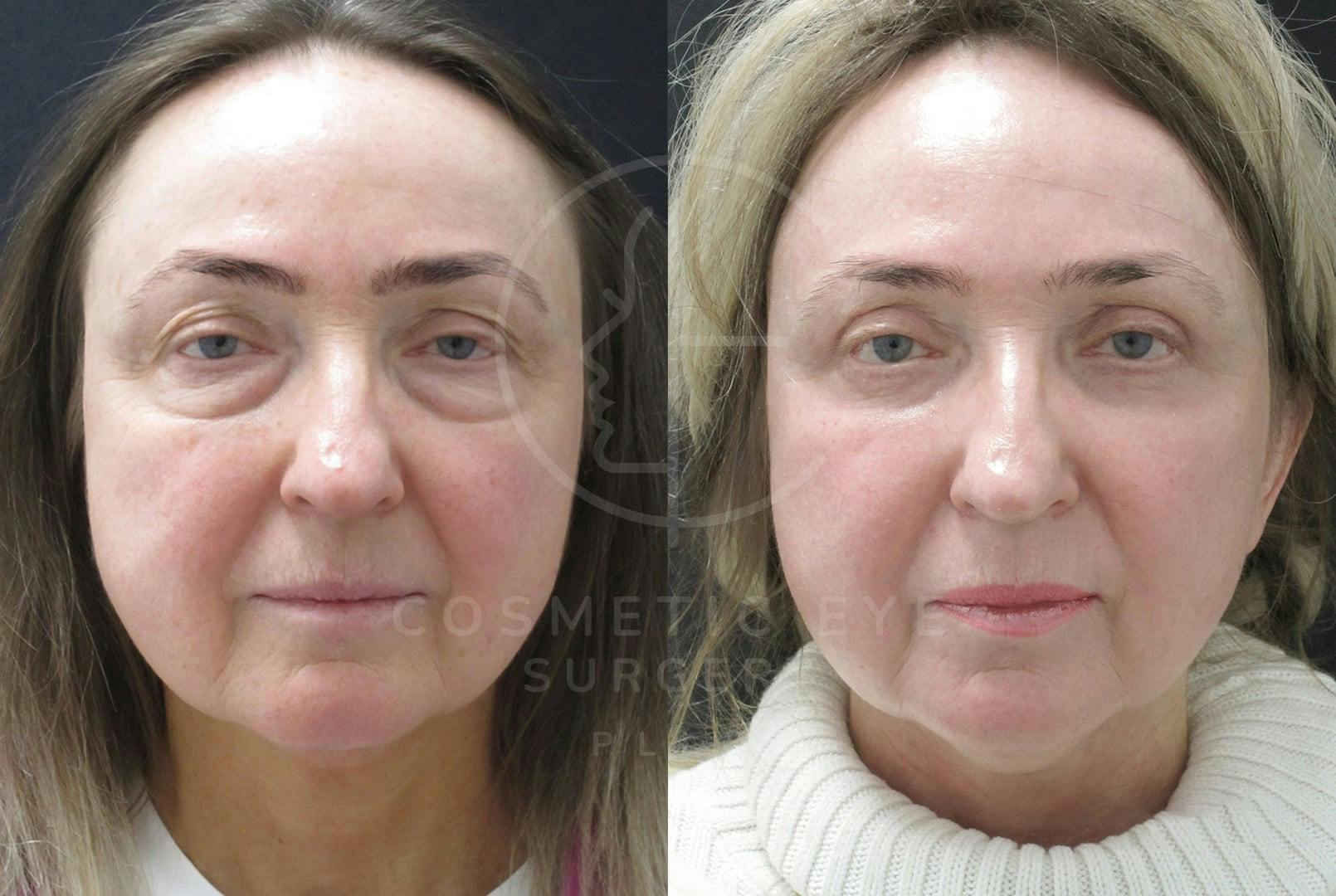 Upper and Lower Eyelid Surgery & Full Face CO₂ LASER Resurfacing Patient Image #4