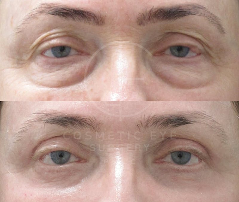 Cosmetic Eye Gallery Before & After Gallery - Patient 325536 - Image 3