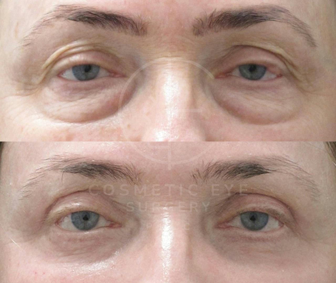 Upper and Lower Eyelid Surgery & Full Face CO₂ LASER Resurfacing Patient Image #3
