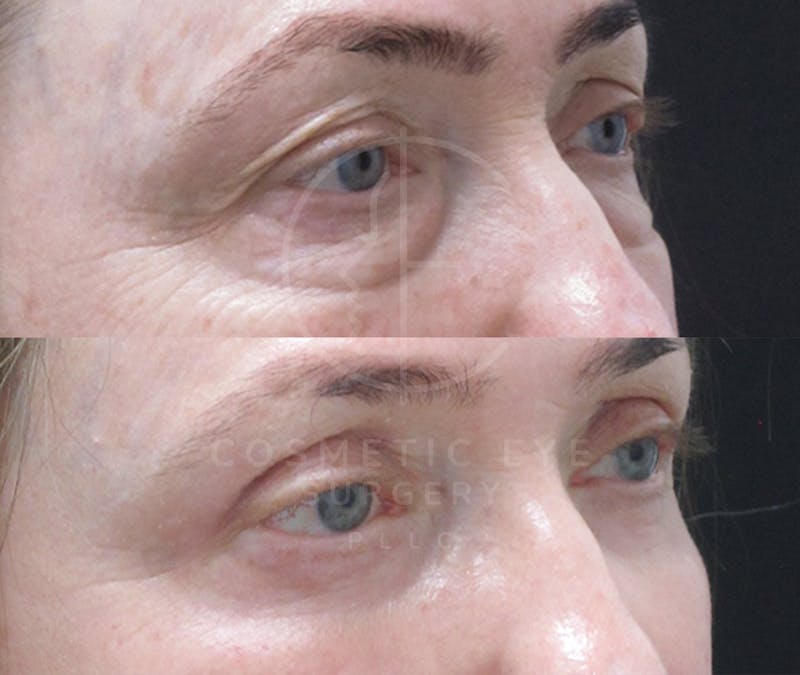 Cosmetic Eye Gallery Before & After Gallery - Patient 325536 - Image 2