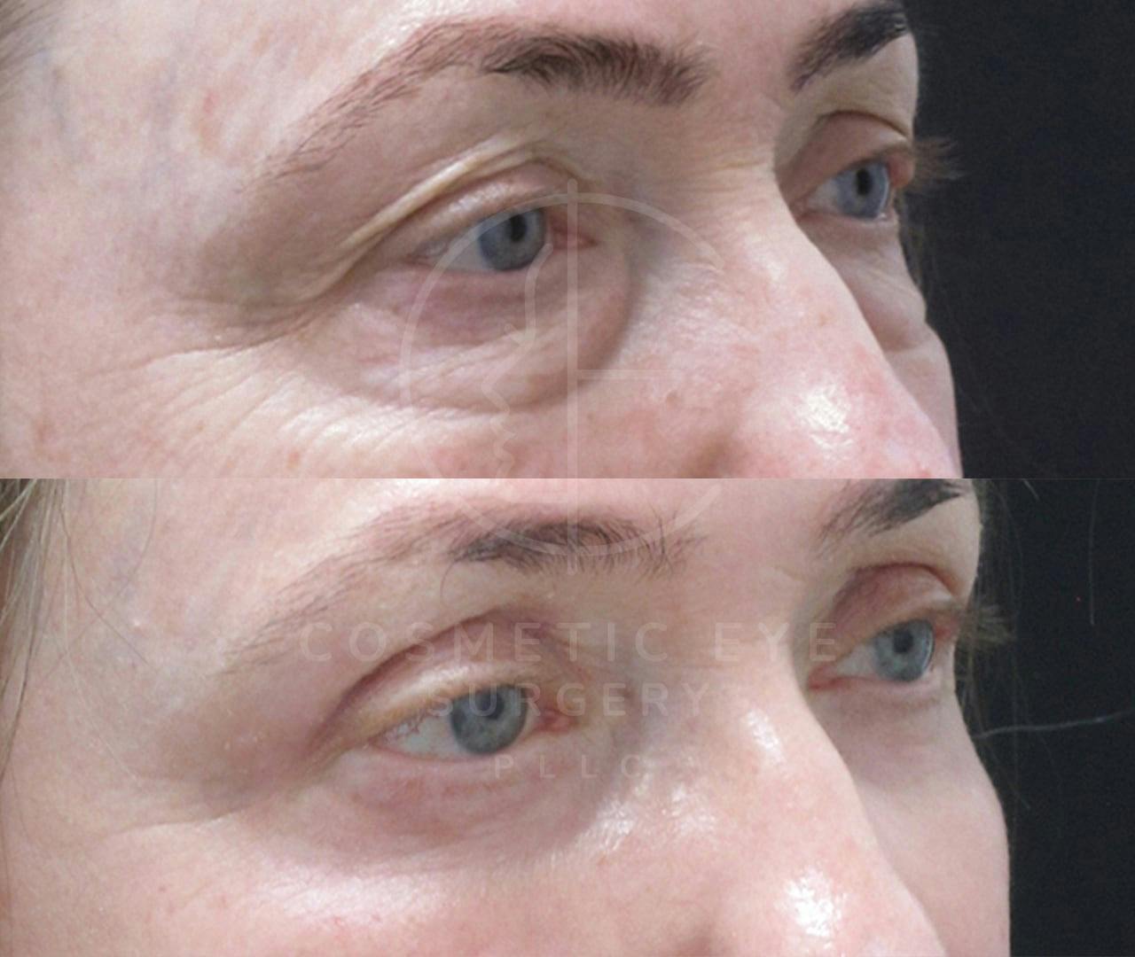 Upper and Lower Eyelid Surgery & Full Face CO₂ LASER Resurfacing Patient Image #2