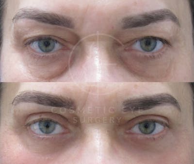 Cosmetic Eye Gallery Before & After Gallery - Patient 150665 - Image 1
