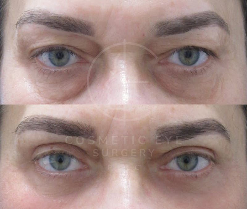 Cosmetic Eye Gallery Before & After Gallery - Patient 150665 - Image 1