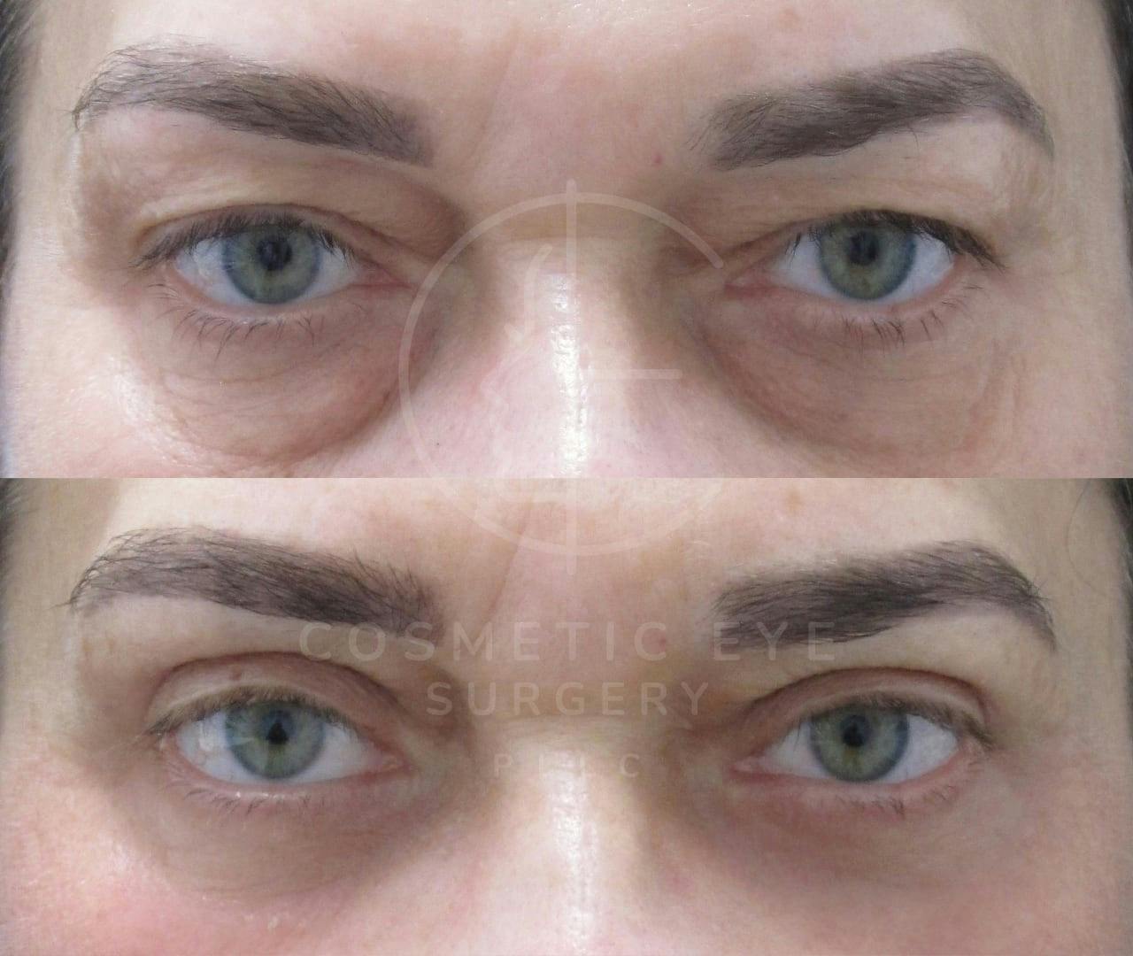 Lower Eyelid Surgery Patient Image #1