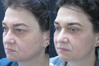 Cosmetic Eye Gallery Before & After Gallery - Patient 150665 - Image 2