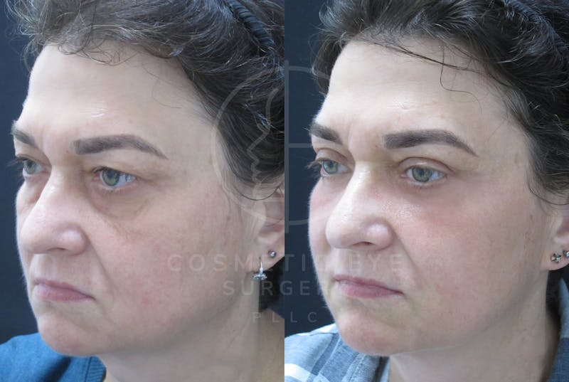 Cosmetic Eye Gallery Before & After Gallery - Patient 150665 - Image 2