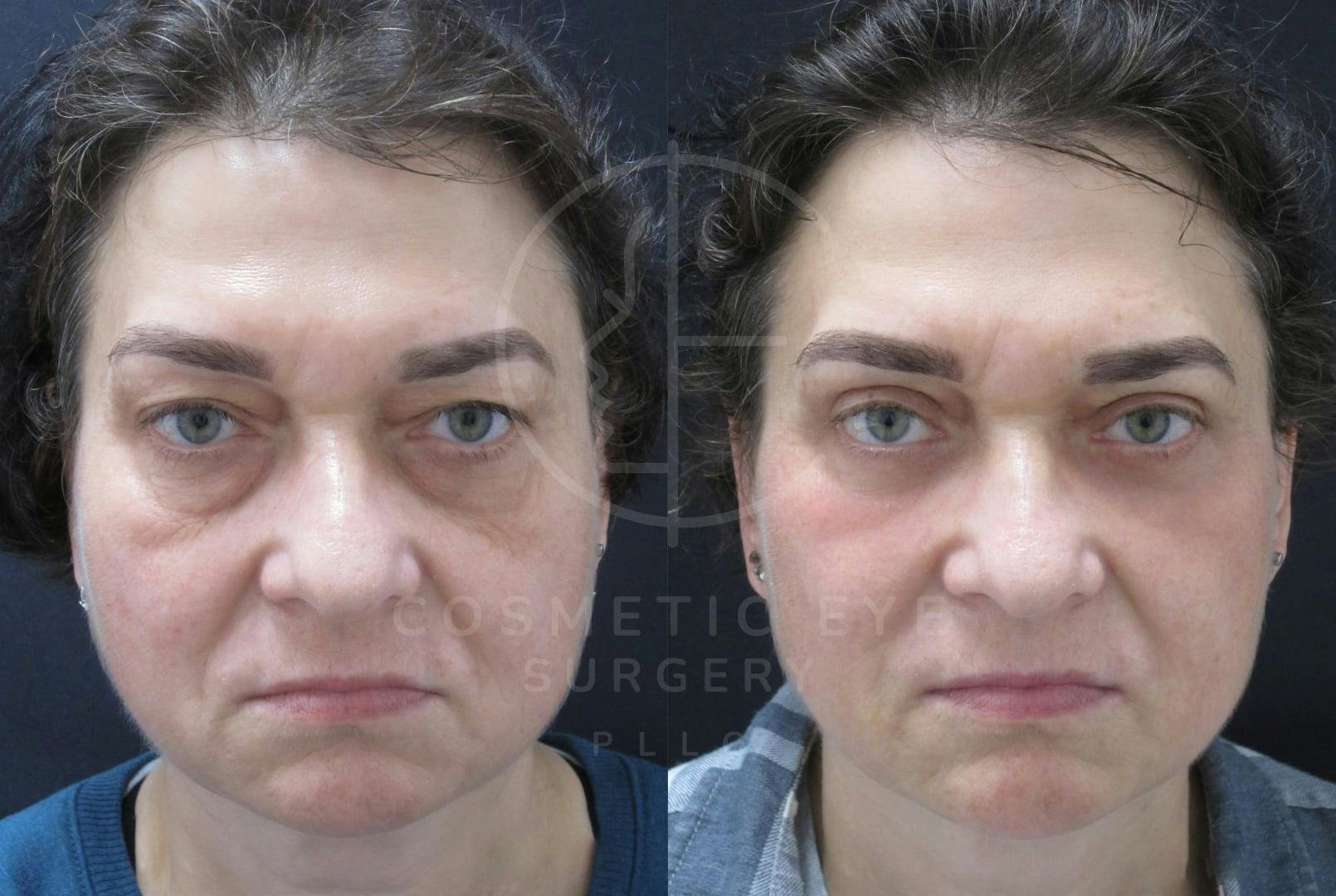 Lower Eyelid Surgery Patient Image #3