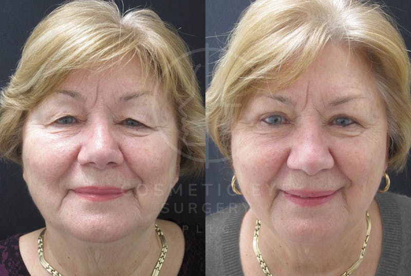 Cosmetic Eye Gallery Before & After Gallery - Patient 159537 - Image 3