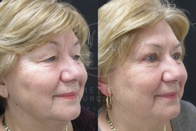 Cosmetic Eye Gallery Before & After Gallery - Patient 159537 - Image 2