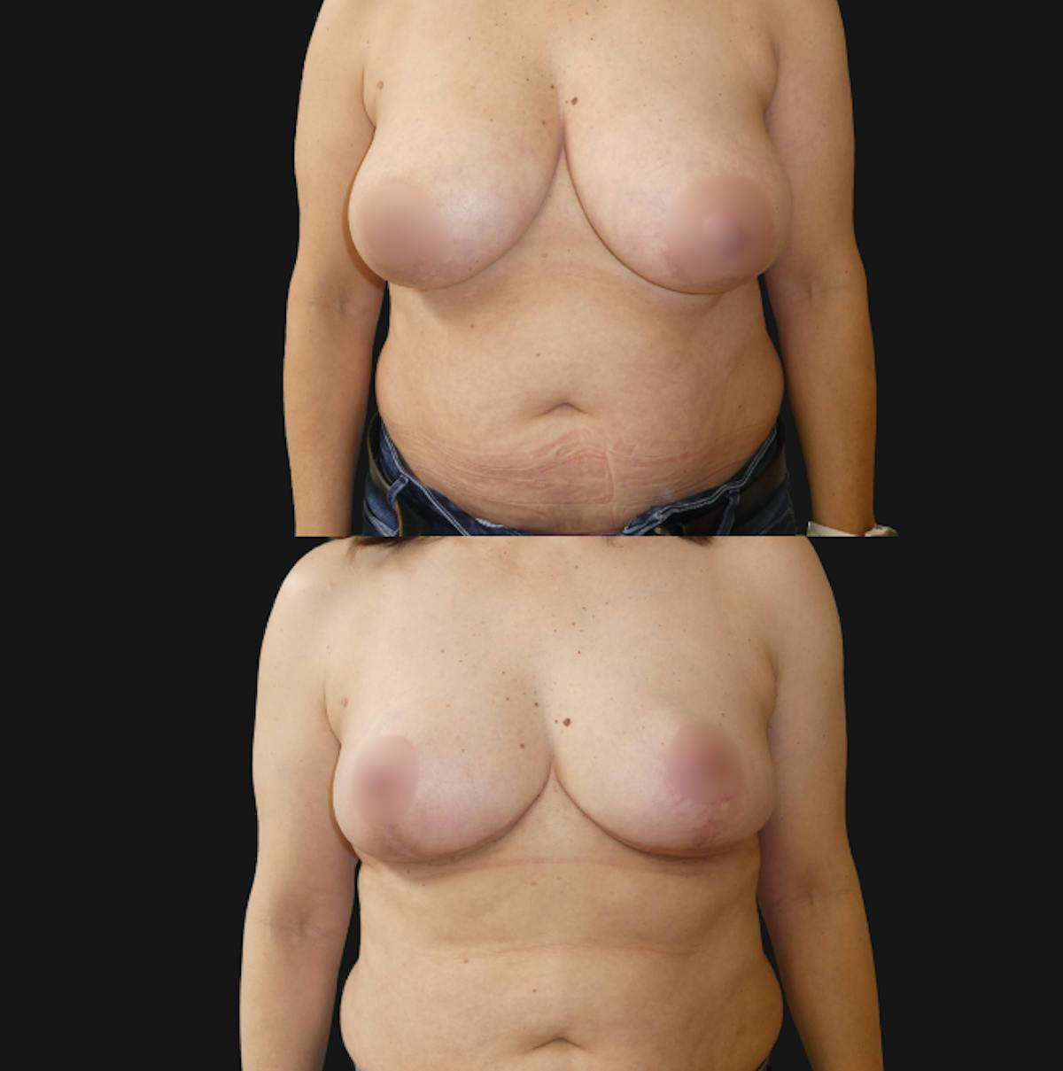 Breast Lift Before & After Gallery - Patient 375755 - Image 1