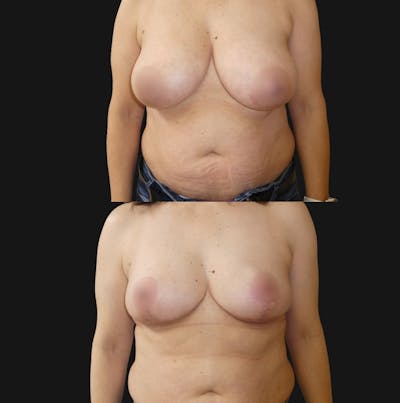 Breast Lift Before & After Gallery - Patient 375755 - Image 1