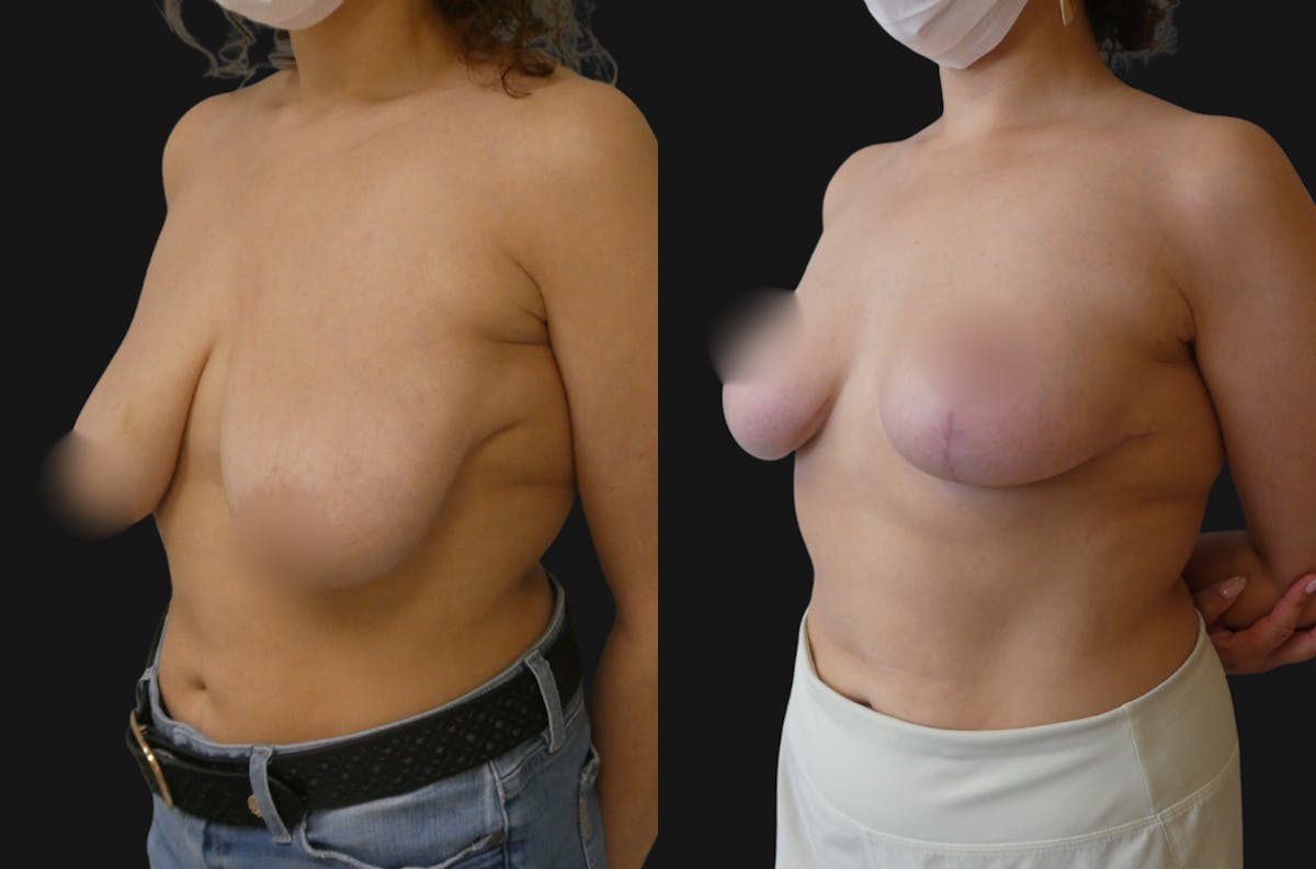 Breast Lift Before & After Gallery - Patient 279750 - Image 1