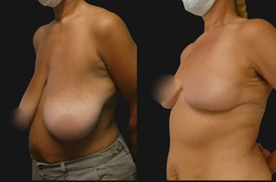 Breast Reduction + Lift Before & After Gallery - Patient 244947 - Image 1