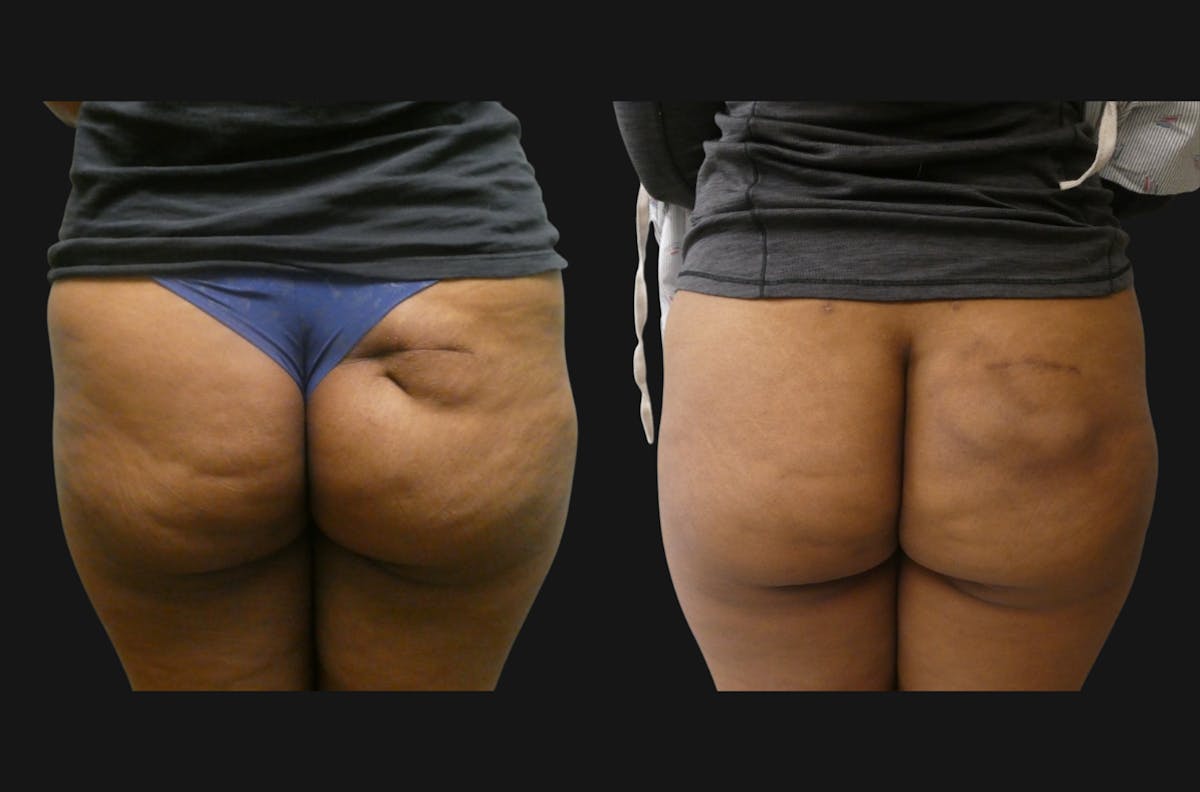 Fat Grafting Before & After Gallery - Patient 314486 - Image 1