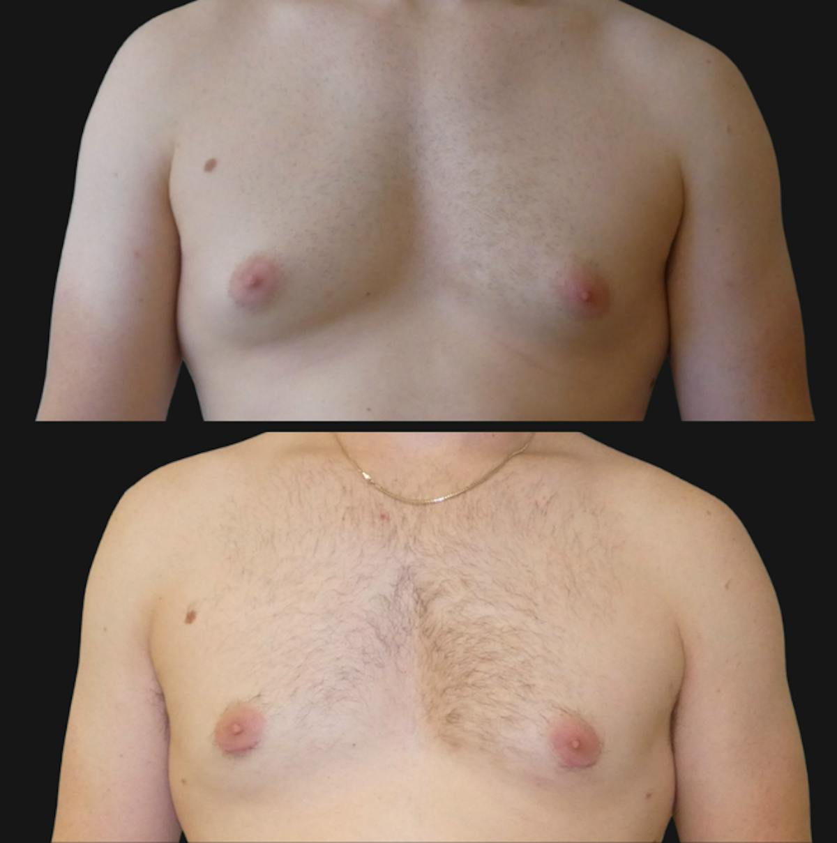 Gynecomastia Before & After Gallery - Patient 268978 - Image 1