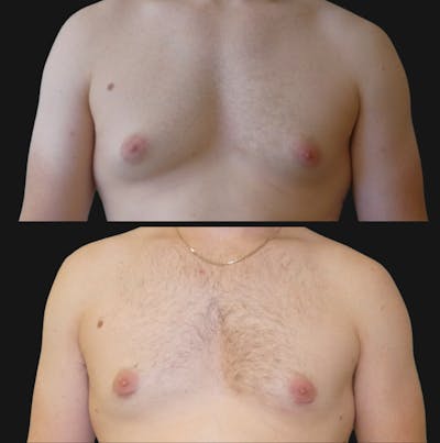 Gynecomastia Before & After Gallery - Patient 268978 - Image 1
