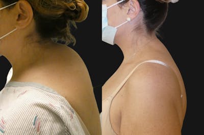 Liposuction Before & After Gallery - Patient 416934 - Image 1