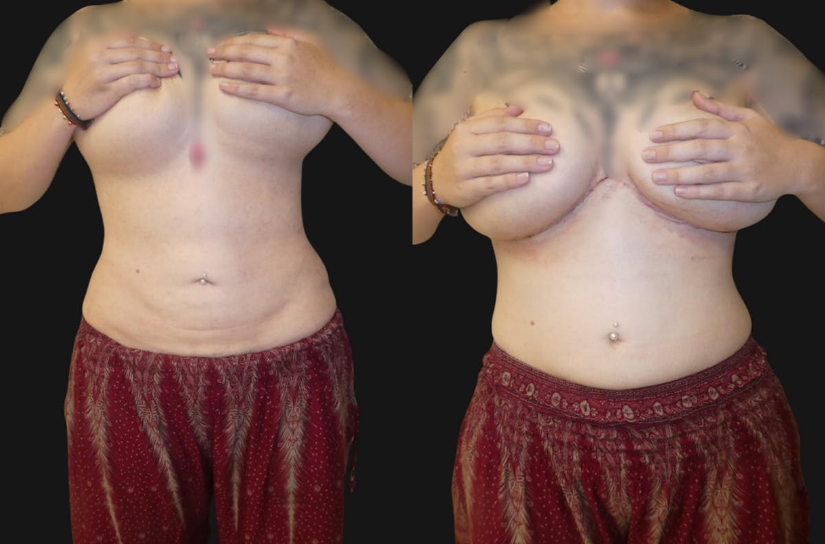 Tummy Tuck / Reverse Abdominoplasty Before & After Gallery - Patient 367091 - Image 1