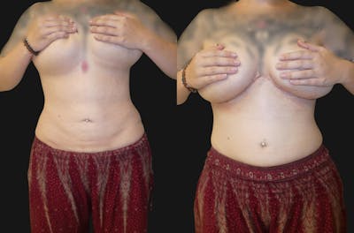 Tummy Tuck / Reverse Abdominoplasty Before & After Gallery - Patient 367091 - Image 1