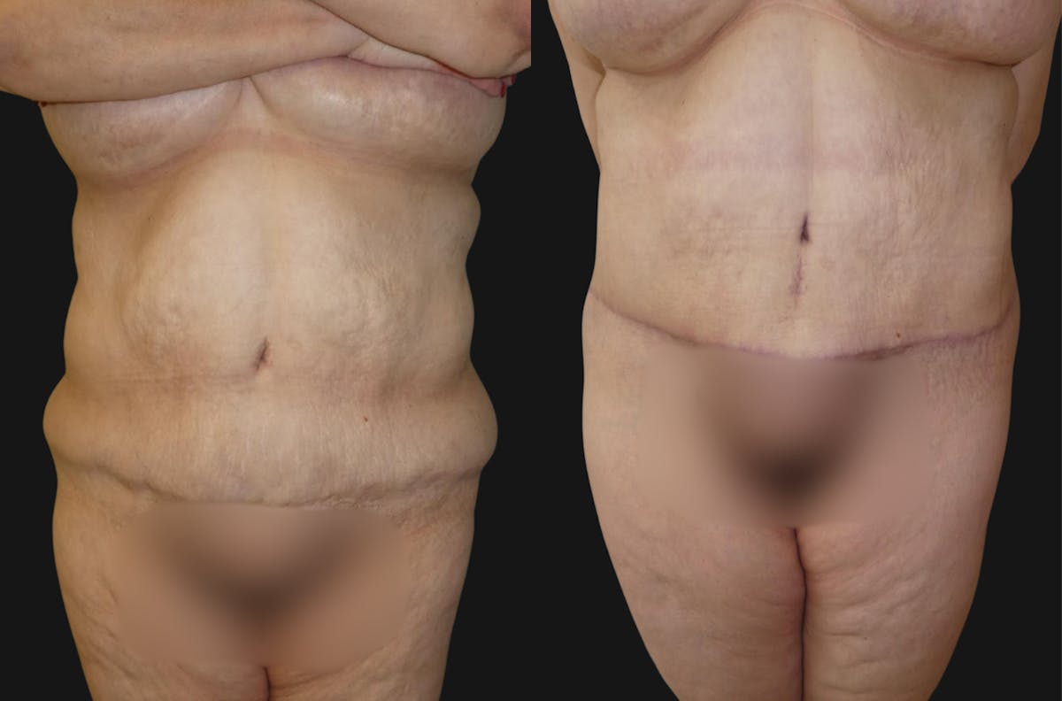 Tummy Tuck / Reverse Abdominoplasty Before & After Gallery - Patient 163478 - Image 1