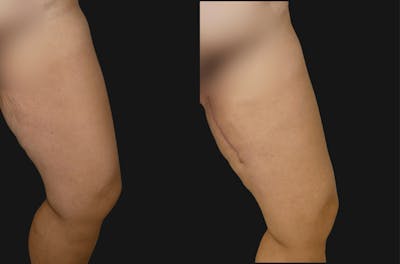Thigh Lift Before & After Gallery - Patient 358090 - Image 1