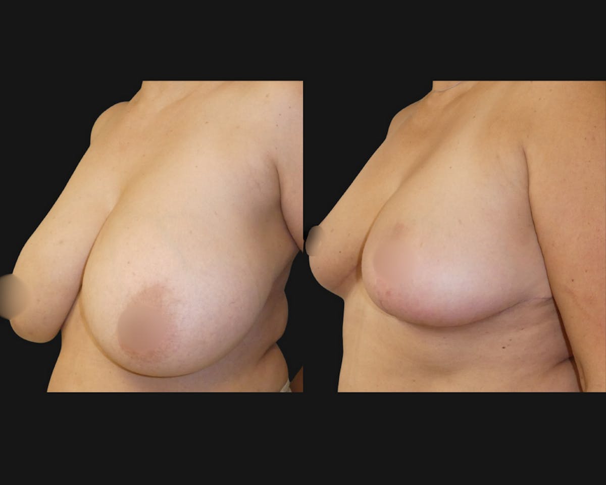 Breast Reduction + Lift Before & After Gallery - Patient 290723 - Image 1