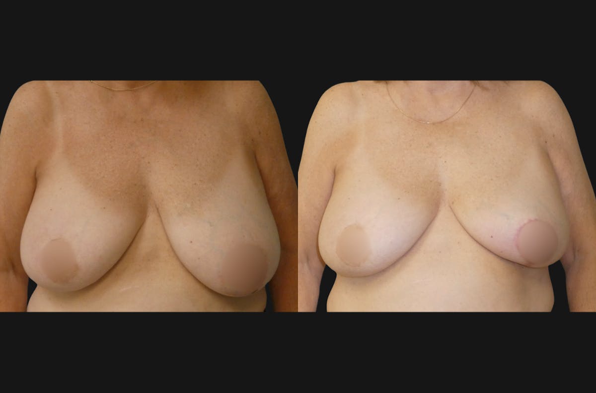 Breast Reduction Before & After Gallery - Patient 690930 - Image 1