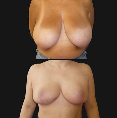 Breast Reduction Before & After Gallery - Patient 397039 - Image 1