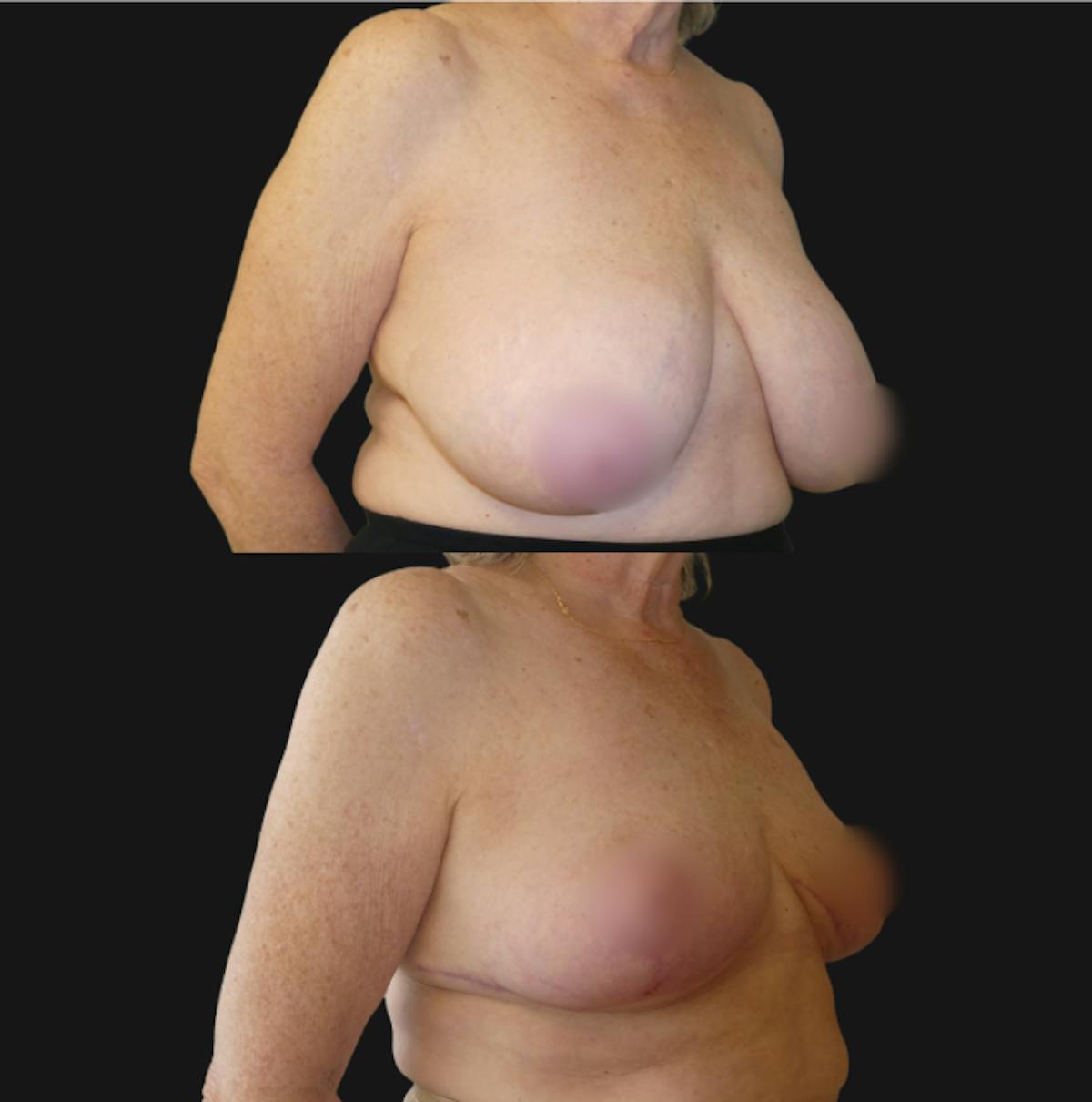 Breast Reduction Before & After Gallery - Patient 299172 - Image 5