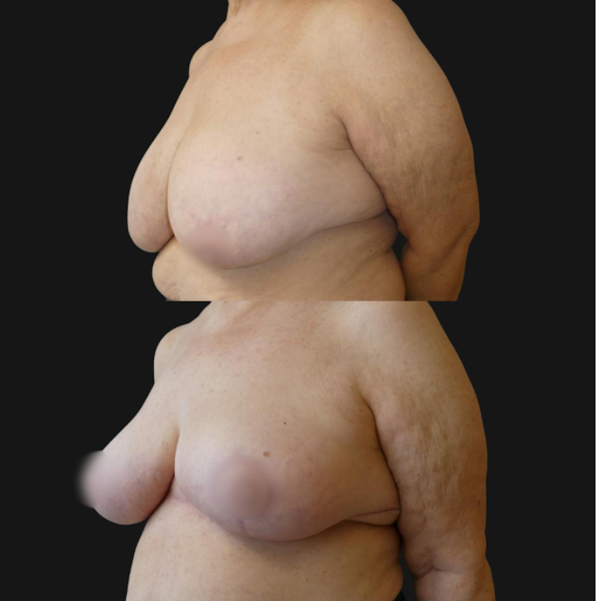 Breast Reduction Before & After Gallery - Patient 451156 - Image 3