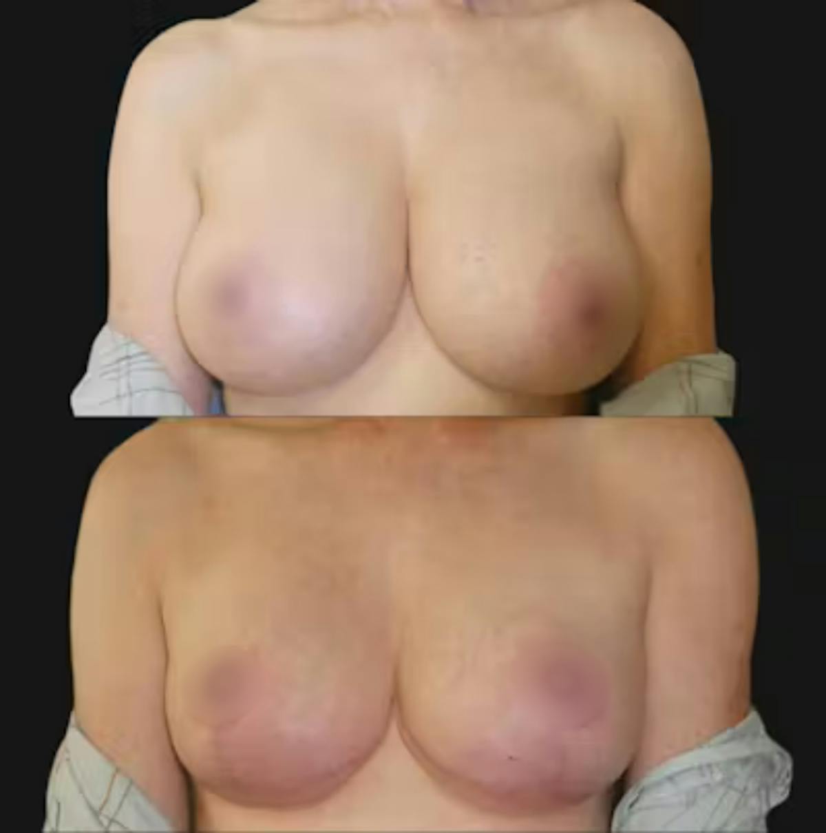 Breast Reduction Before & After Gallery - Patient 245981 - Image 1