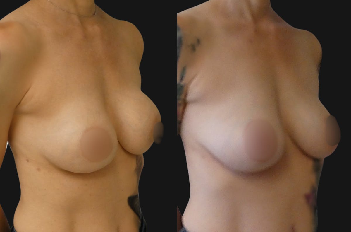 Breast Revision / Implant Exchange Before & After Gallery - Patient 142162 - Image 4