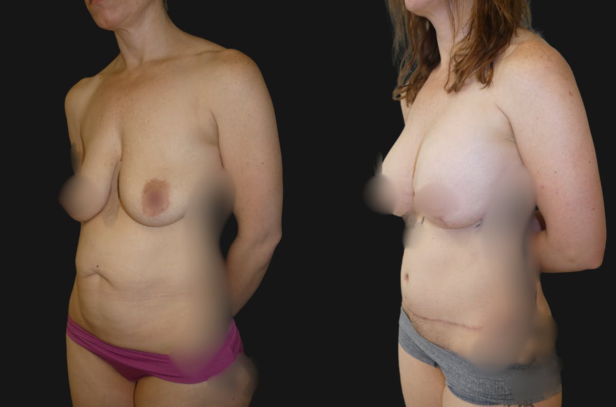 Mommy Makeover Before & After Gallery - Patient 540026 - Image 1