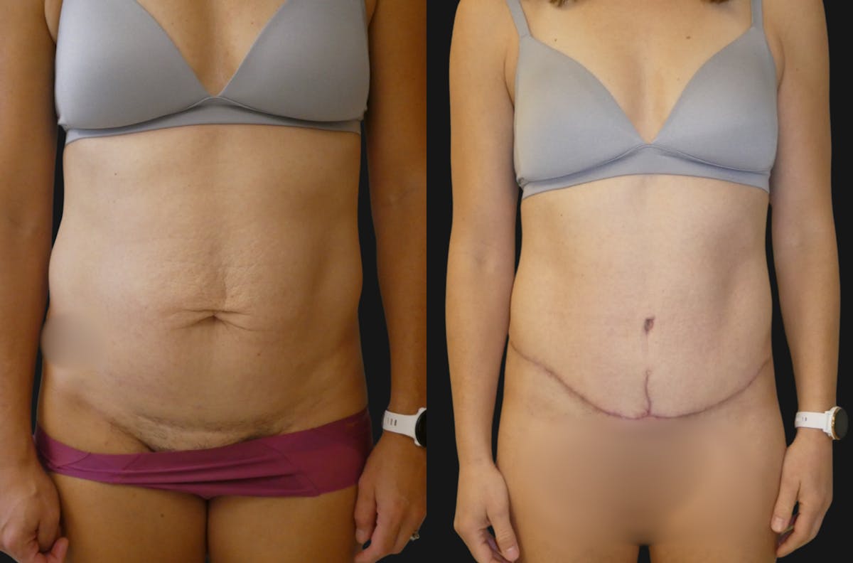 Tummy Tuck / Reverse Abdominoplasty Before & After Gallery - Patient 412982 - Image 1