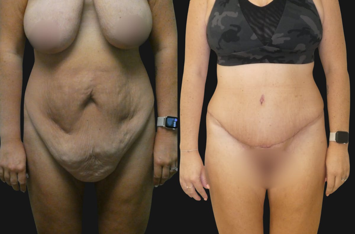 Tummy Tuck / Reverse Abdominoplasty Before & After Gallery - Patient 197635 - Image 1