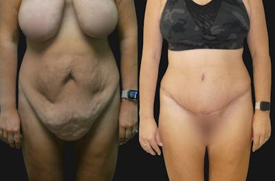 Tummy Tuck / Reverse Abdominoplasty Before & After Gallery - Patient 197635 - Image 1