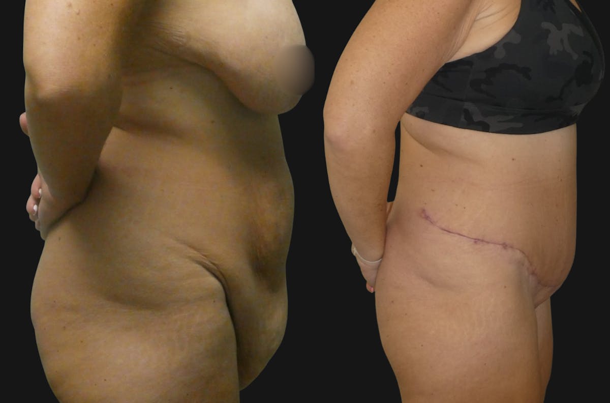 Tummy Tuck / Reverse Abdominoplasty Before & After Gallery - Patient 197635 - Image 3