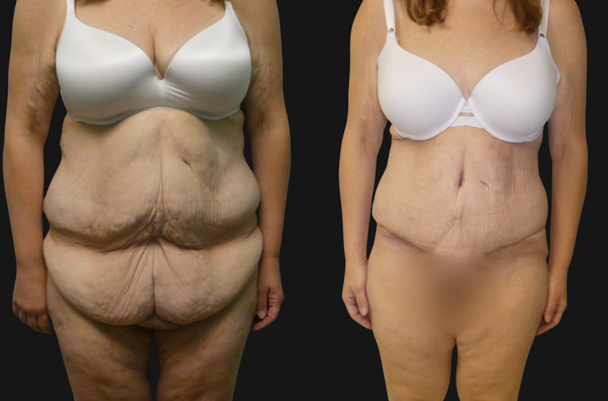 Tummy Tuck / Reverse Abdominoplasty Before & After Gallery - Patient 135485 - Image 1