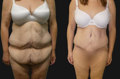 Tummy Tuck / Reverse Abdominoplasty Before & After Gallery - Patient 135485 - Image 1