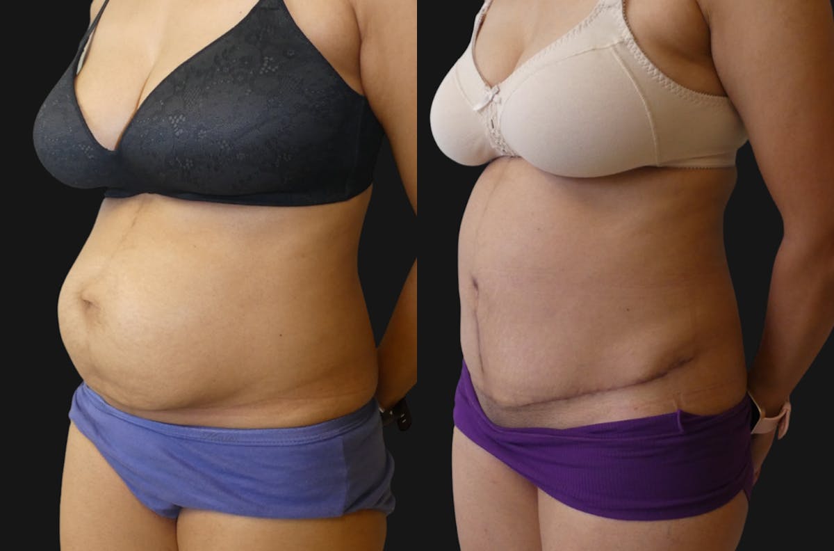 Tummy Tuck / Reverse Abdominoplasty Before & After Gallery - Patient 323226 - Image 1