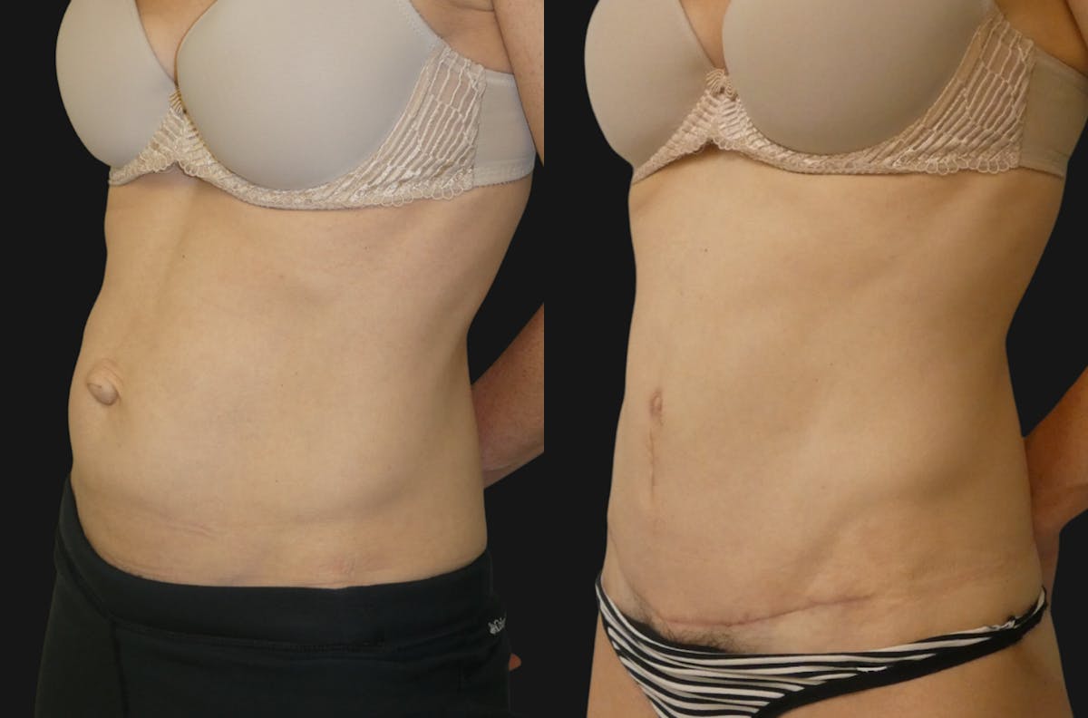 Tummy Tuck / Reverse Abdominoplasty Before & After Gallery - Patient 404911 - Image 1