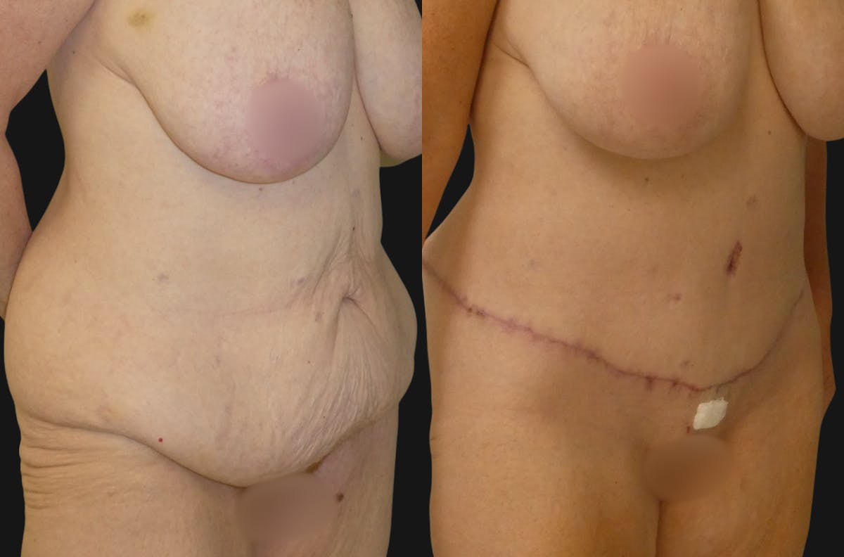 Tummy Tuck / Reverse Abdominoplasty Before & After Gallery - Patient 429153 - Image 3