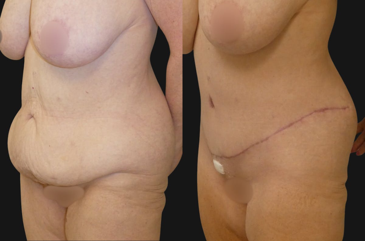 Tummy Tuck / Reverse Abdominoplasty Before & After Gallery - Patient 429153 - Image 1