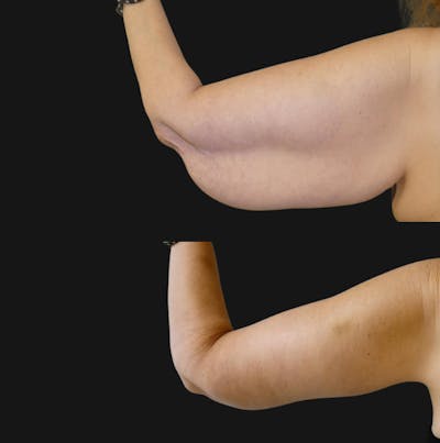 Arm Lift / Thigh Lift Before & After Gallery - Patient 149516 - Image 1