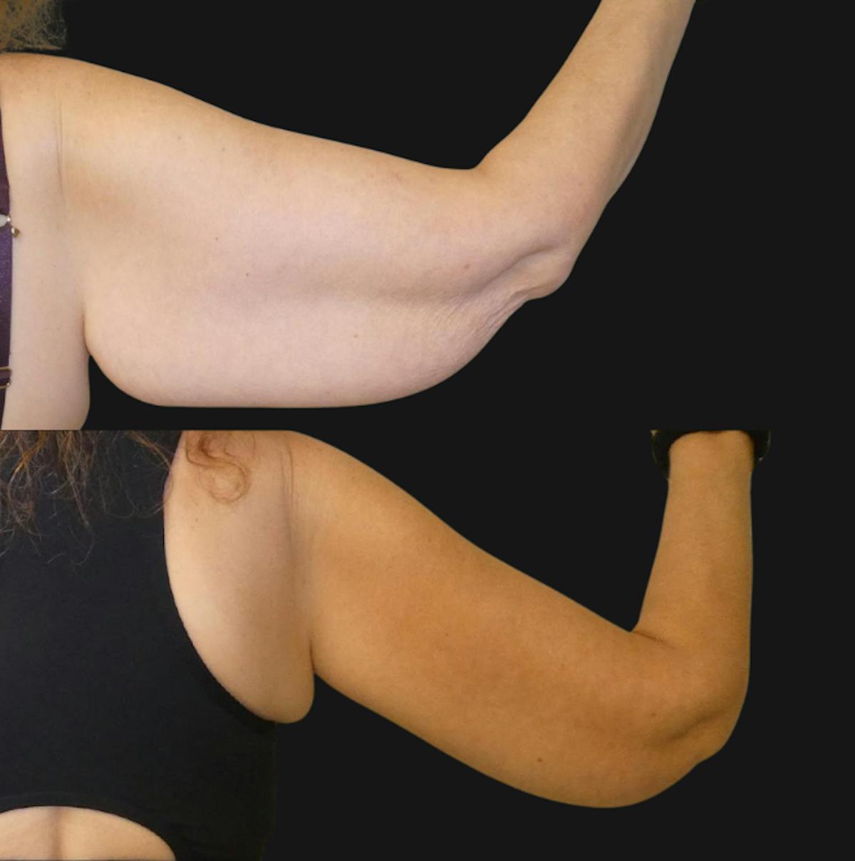 Arm Lift / Thigh Lift Before & After Gallery - Patient 149516 - Image 3
