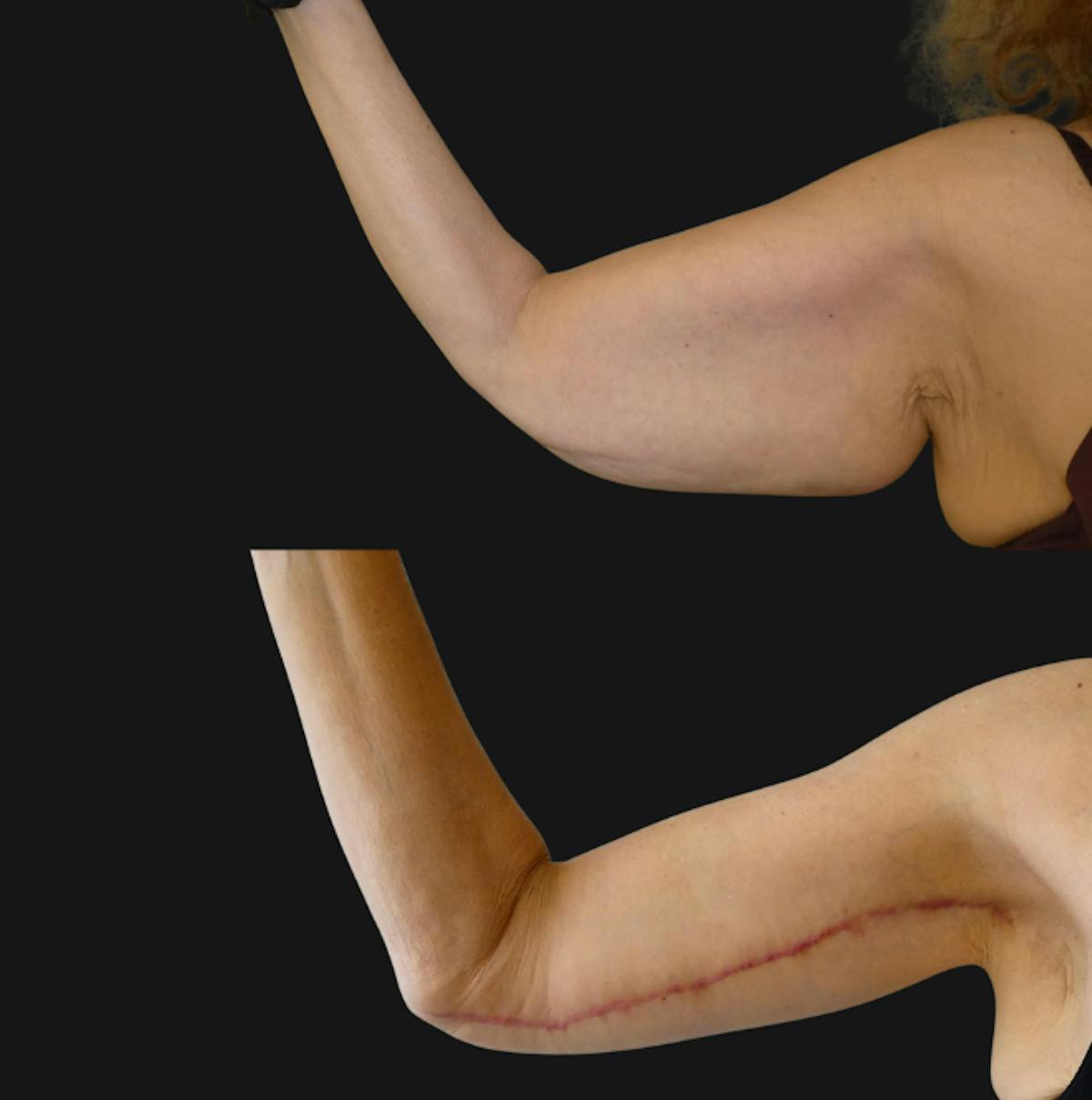 Arm Lift / Thigh Lift Before & After Gallery - Patient 149516 - Image 2